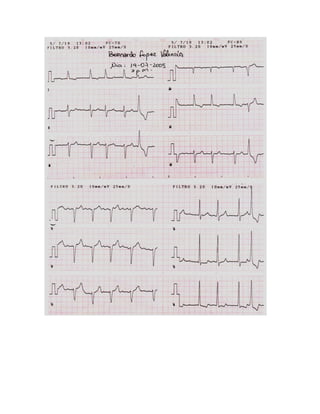 35 electrocardiogramas parte 2