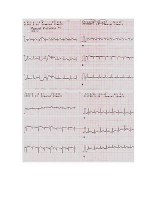 35 electrocardiogramas parte 2
