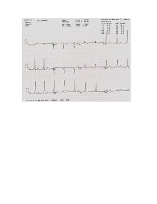 35 electrocardiogramas parte 2