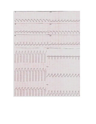 35 electrocardiogramas parte 2
