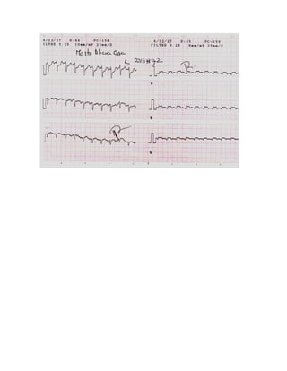 35 electrocardiogramas parte 2
