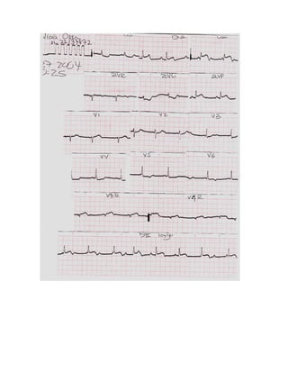 35 electrocardiogramas parte 2