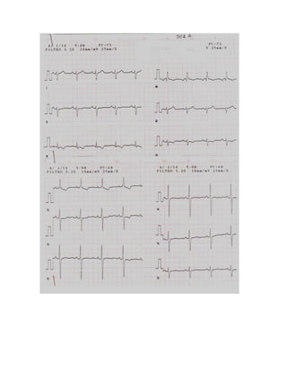 35 electrocardiogramas parte 2