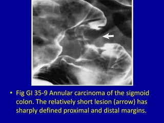 35 narrowing of the colon | PPTX