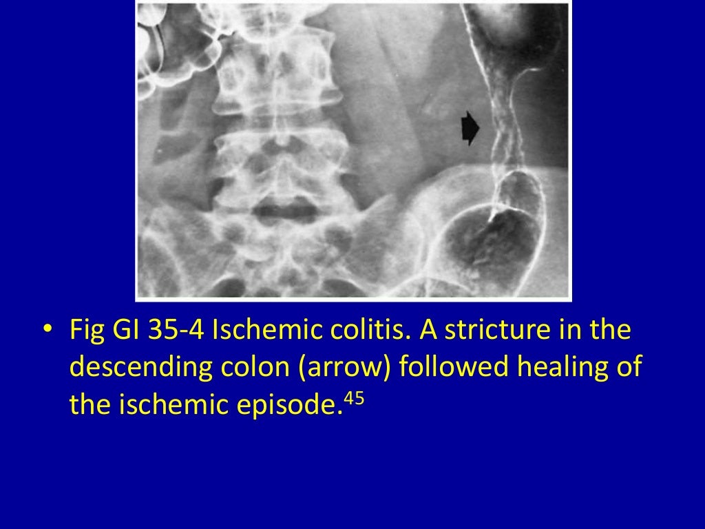 35 narrowing of the colon
