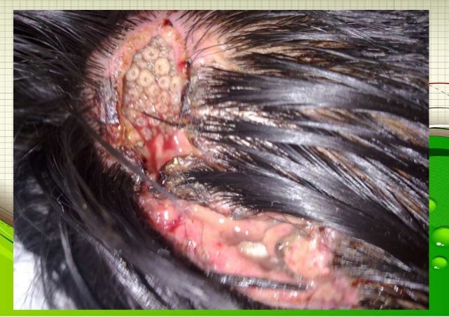 tengo costras en el cuero cabelludo 35 parasitosis dermicas tengo costras en el cuero cabelludo 35 parasitosis dermicas