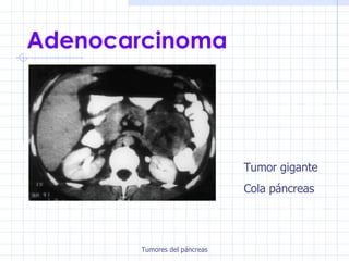 Adenocarcinoma Tumor gigante Cola páncreas 