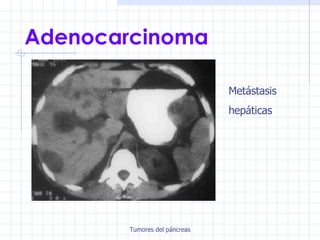 Adenocarcinoma Metástasis hepáticas 