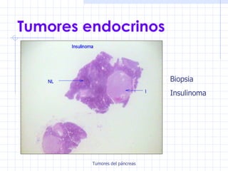 Tumores endocrinos Biopsia Insulinoma 