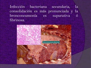 Infección bacteriana secundaria, la
consolidación es más pronunciada y la
bronconeumonía es supurativa ó
fibrinosa.
 