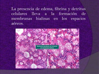 La presencia de edema, fibrina y detritus
celulares lleva a la formación de
membranas hialinas en los espacios
aéreos.
 