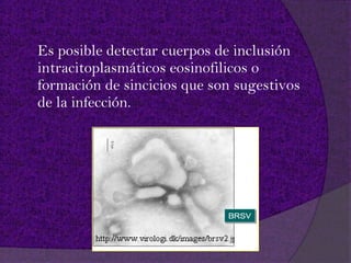Es posible detectar cuerpos de inclusión
intracitoplasmáticos eosinofilicos o
formación de sincicios que son sugestivos
de la infección.
 
