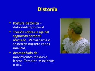Distonía 
• Postura distónica = 
deformidad postural 
• Torsión sobre un eje del 
segmento corporal 
afectado. Permanente o 
sostenida durante varios 
minutos. 
• Acompañado de: 
movimientos rápidos o 
lentos. Temblor, mioclonías 
o tics. 
 