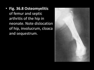 • Fig. 36.8 Osteomyelitis
of femur and septic
arthritis of the hip in
neonate. Note dislocation
of hip, involucrum, cloaca
and sequestrum.
 