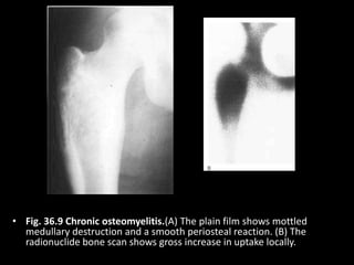 • Fig. 36.9 Chronic osteomyelitis.(A) The plain film shows mottled
medullary destruction and a smooth periosteal reaction. (B) The
radionuclide bone scan shows gross increase in uptake locally.
 