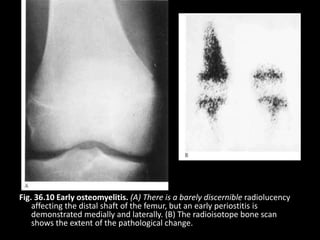 Fig. 36.10 Early osteomyelitis. (A) There is a barely discernible radiolucency
affecting the distal shaft of the femur, but an early periostitis is
demonstrated medially and laterally. (B) The radioisotope bone scan
shows the extent of the pathological change.
 
