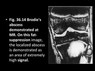 • Fig. 36.14 Brodie's
abscess
demonstrated at
MR. On this fat-
suppression image,
the localized abscess
is demonstrated as
an area of extremely
high signal.
 