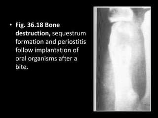 • Fig. 36.18 Bone
destruction, sequestrum
formation and periostitis
follow implantation of
oral organisms after a
bite.
 