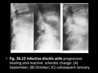 • Fig. 36.22 Infective discitis with progressive
healing and reactive sclerotic change: (A)
September; (B) October; (C) subsequent January.
 