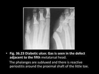 • Fig. 36.23 Diabetic ulcer. Gas is seen in the defect
adjacent to the fifth metatarsal head.
The phalanges are subluxed and there is reactive
periostitis around the proximal shaft of the little toe.
 