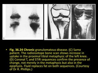 • Fig. 36.24 Chronic granulomatous disease. (C) Same
patient. The radioisotope bone scan shows increase in
uptake in the proximal tibial metaphysic of the left knee.
(D) Coronal T, and STIR sequences confirm the presence of
change, not merely in the metaphysis but also in the
epiphysis. Fluid replaces fat on both sequences. (Courtesy
of Dr R. Phillips.)
 