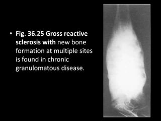 • Fig. 36.25 Gross reactive
sclerosis with new bone
formation at multiple sites
is found in chronic
granulomatous disease.
 