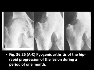 • Fig. 36.26 (A-C) Pyogenic arthritis of the hip-
rapid progression of the lesion during a
period of one month.
 