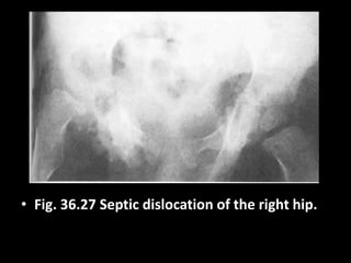 • Fig. 36.27 Septic dislocation of the right hip.
 
