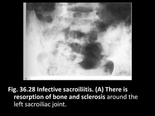 Fig. 36.28 Infective sacroiliitis. (A) There is
resorption of bone and sclerosis around the
left sacroiliac joint.
 