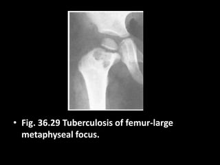 • Fig. 36.29 Tuberculosis of femur-large
metaphyseal focus.
 