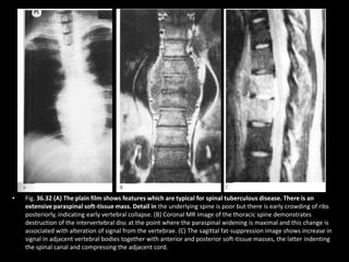 • Fig. 36.32 (A) The plain film shows features which are typical for spinal tuberculous disease. There is an
extensive paraspinal soft-tissue mass. Detail in the underlying spine is poor but there is early crowding of ribs
posteriorly, indicating early vertebral collapse. (B) Coronal MR image of the thoracic spine demonstrates
destruction of the intervertebral disc at the point where the paraspinal widening is maximal and this change is
associated with alteration of signal from the vertebrae. (C) The sagittal fat-suppression image shows increase in
signal in adjacent vertebral bodies together with anterior and posterior soft-tissue masses, the latter indenting
the spinal canal and compressing the adjacent cord.
 