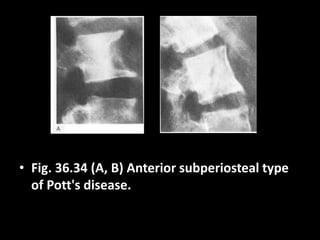 • Fig. 36.34 (A, B) Anterior subperiosteal type
of Pott's disease.
 