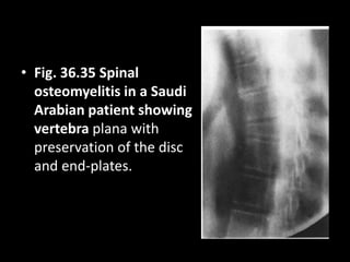 • Fig. 36.35 Spinal
osteomyelitis in a Saudi
Arabian patient showing
vertebra plana with
preservation of the disc
and end-plates.
 