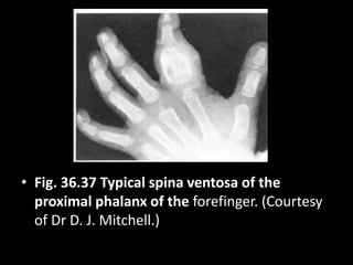 • Fig. 36.37 Typical spina ventosa of the
proximal phalanx of the forefinger. (Courtesy
of Dr D. J. Mitchell.)
 
