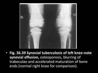 • Fig. 36.39 Synovial tuberculosis of left knee-note
synovial effusion, osteoporosis, blurring of
trabeculae and accelerated maturation of bone
ends (normal right knee for comparison).
 
