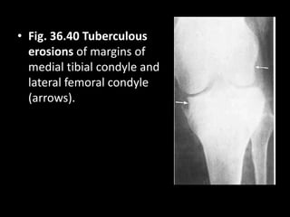 • Fig. 36.40 Tuberculous
erosions of margins of
medial tibial condyle and
lateral femoral condyle
(arrows).
 