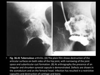• Fig. 36.41 Tuberculous arthritis. (A) The plain film shows destruction of the
articular surfaces on both sides of the hip joint, with narrowing of the joint
space and subarticular cyst formation. (B) At arthrography the presence of an
irregular and shrunken synovial capsule is demonstrated. Defects are shown in
the acetabulum and on the femoral head. Infection has resulted in a restrictive
capsulitis and destruction of cartilage and bone.
 