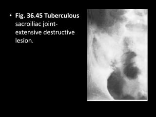 • Fig. 36.45 Tuberculous
sacroiliac joint-
extensive destructive
lesion.
 