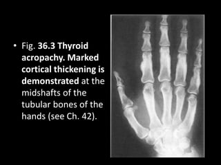 • Fig. 36.3 Thyroid
acropachy. Marked
cortical thickening is
demonstrated at the
midshafts of the
tubular bones of the
hands (see Ch. 42).
 