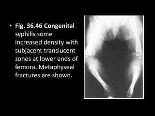 • Fig. 36.46 Congenital
syphilis some
increased density with
subjacent translucent
zones at lower ends of
femora. Metaphyseal
fractures are shown.
 
