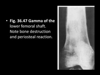 • Fig. 36.47 Gamma of the
lower femoral shaft.
Note bone destruction
and periosteal reaction.
 