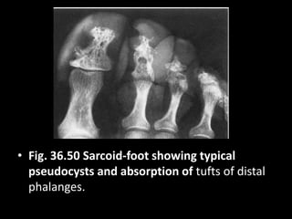 • Fig. 36.50 Sarcoid-foot showing typical
pseudocysts and absorption of tufts of distal
phalanges.
 