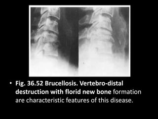 • Fig. 36.52 Brucellosis. Vertebro-distal
destruction with florid new bone formation
are characteristic features of this disease.
 