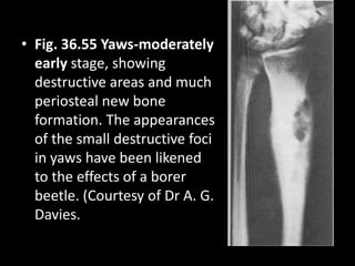 • Fig. 36.55 Yaws-moderately
early stage, showing
destructive areas and much
periosteal new bone
formation. The appearances
of the small destructive foci
in yaws have been likened
to the effects of a borer
beetle. (Courtesy of Dr A. G.
Davies.
 