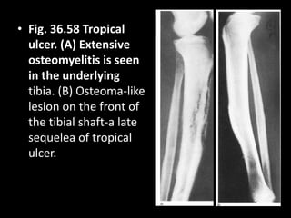 • Fig. 36.58 Tropical
ulcer. (A) Extensive
osteomyelitis is seen
in the underlying
tibia. (B) Osteoma-like
lesion on the front of
the tibial shaft-a late
sequelea of tropical
ulcer.
 