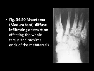 • Fig. 36.59 Mycetoma
(Madura foot)-diffuse
infiltrating destruction
affecting the whole
tarsus and proximal
ends of the metatarsals.
 