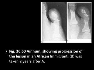 • Fig. 36.60 Ainhum, showing progression of
the lesion in an African Immigrant. (B) was
taken 2 years after A.
 