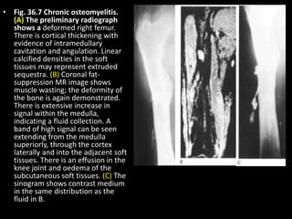 • Fig. 36.7 Chronic osteomyelitis.
(A) The preliminary radiograph
shows a deformed right femur.
There is cortical thickening with
evidence of intramedullary
cavitation and angulation. Linear
calcified densities in the soft
tissues may represent extruded
sequestra. (B) Coronal fat-
suppression MR image shows
muscle wasting; the deformity of
the bone is again demonstrated.
There is extensive increase in
signal within the medulla,
indicating a fluid collection. A
band of high signal can be seen
extending from the medulla
superiorly, through the cortex
laterally and into the adjacent soft
tissues. There is an effusion in the
knee joint and oedema of the
subcutaneous soft tissues. (C) The
sinogram shows contrast medium
in the same distribution as the
fluid in B.
 