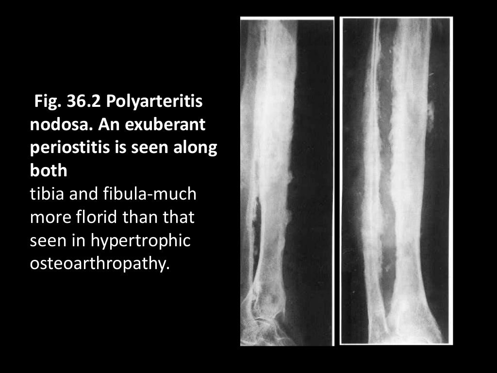 36 DAVID SUTTON PICTURES PERIOSTEAL REACTION BONE AND JOINT INFECTION…