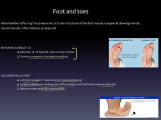 Foot and toes
Abnormalities affecting the osseous and articular structures of the foot may be congenital, developmental,
neuromuscular, inflammatory, or acquired
METATARSUS ADDUCTUS
❑ Adduction of the forefoot relative to the hindfoot
❑ Common in newborn (intrauterine molding)
CALCANEOVALGUS FEET
❑ common in newborn (secondary to in utero positioning)
❑ excessive dorsiflexion and eversion of the hindfoot, and the forefoot may be abducted
❑ Resolves within the 1st few weeks of life
-
I
-
- -
-
---
-
 